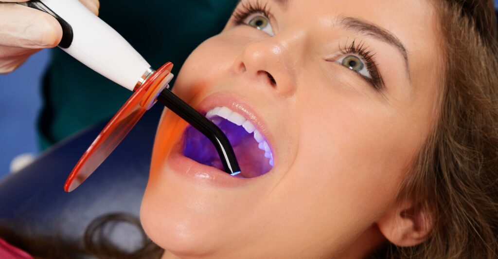 Tooth Colored Fillings Dental Solutions of Encinitas