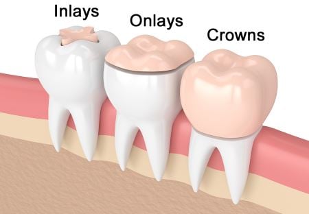 Benefits of Inlays and Onlays