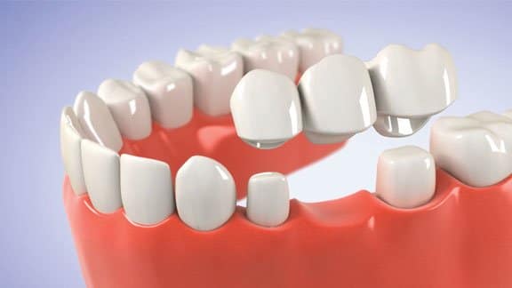 Benefits of Dental Crowns