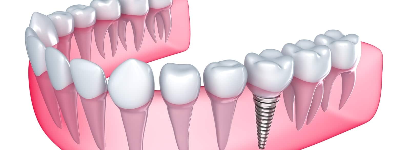 Dental Implants Dental Solutions of Encinitas