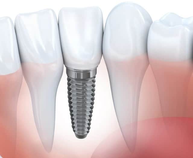 Dental Implants