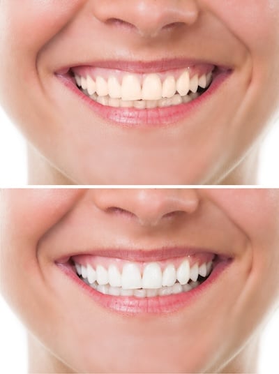 whitening before and after